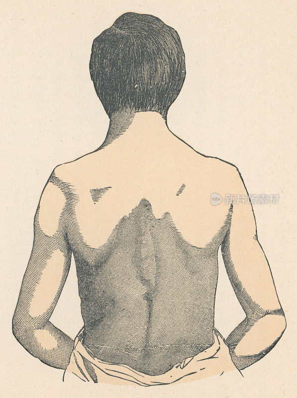 医学插图的年轻成年男子与飞溅的肩膀- 19世纪